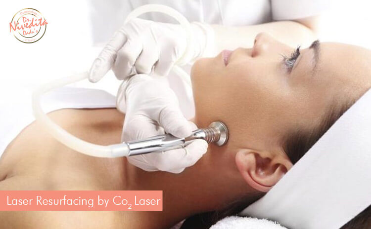 laser-resurfacing-by-co2-laser