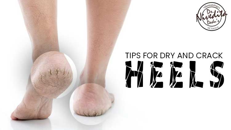 Home Remedies for Dry Feet & Cracked Heels | Coconut for Life