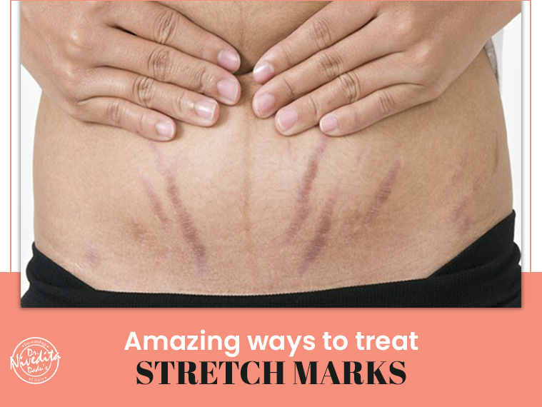 STRETCH MARKS & COMMON RISK FACTORS YOU MUST KNOW - My Lilli Pilli