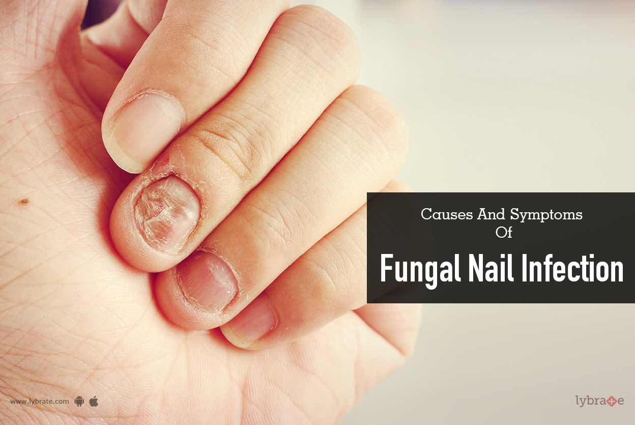 Premium Photo  Fungal nail infection onychomycosis also called tinea  unguium