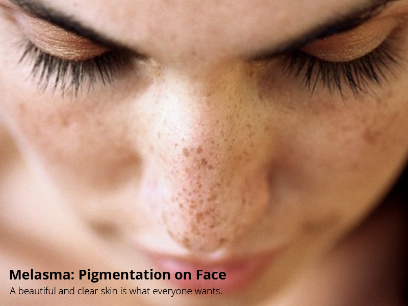 Melasma Pigmentation on Face