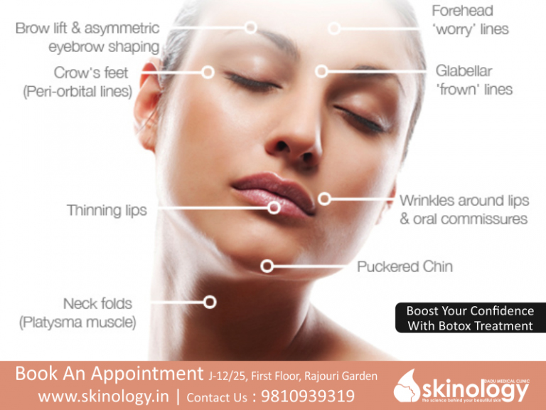 Anti Wrinkle Injections and wrinkle fillers Treatment